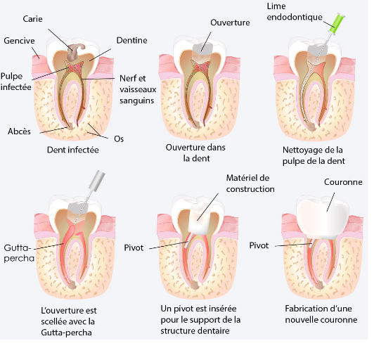 Le traitement de canal, un traitement d’endodontie